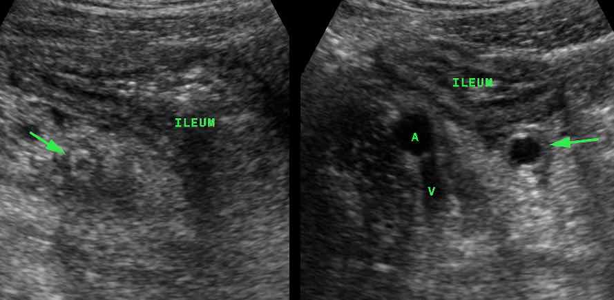 Appendicitis (arrow) causing secondary thickening of the neighboring ileum.(A and V= iliac artery and vein)