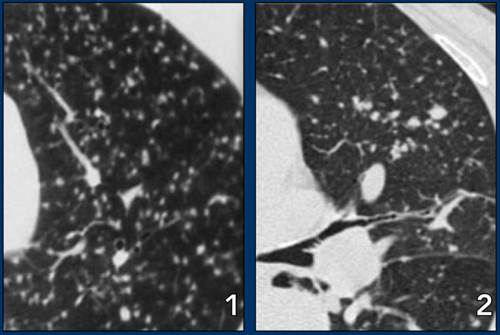 LEFT: miliary TB. RIGHT: metastases