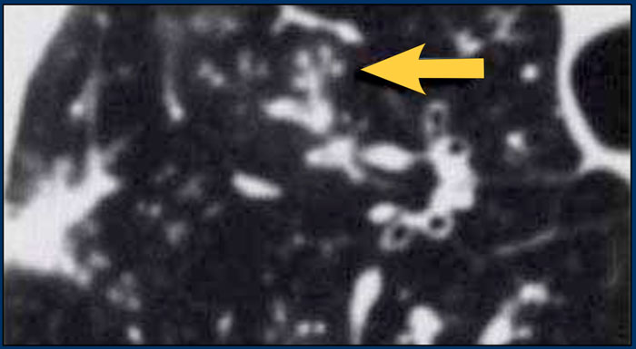 Endobronchial spread of TB with tree-in-bud