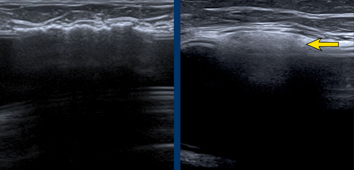 Capsular calcifications versus extracapsular leakage of Silicone.