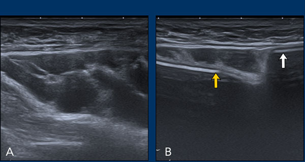 Intracapsular rupture