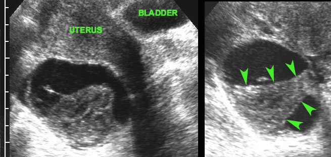 Haemorrhagic cyst with clot.