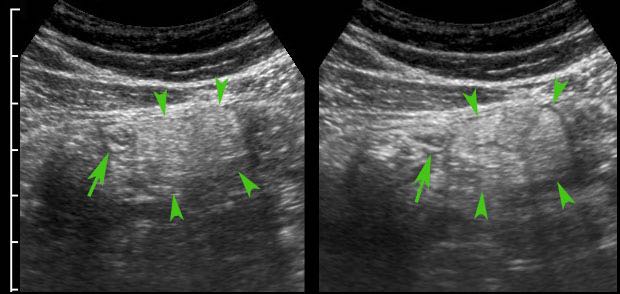 Epiploic appendagitis