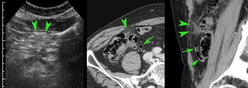 Epiploic appendagitis