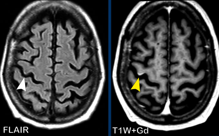 Gyral enhancement in a woman with breast cancer