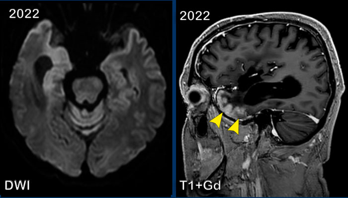 Stroke-like Migraine Attacks after Radiation Therapy