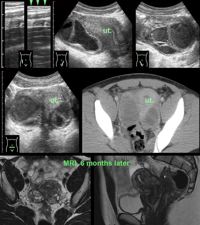 Bilateral infected endometriotic cysts.