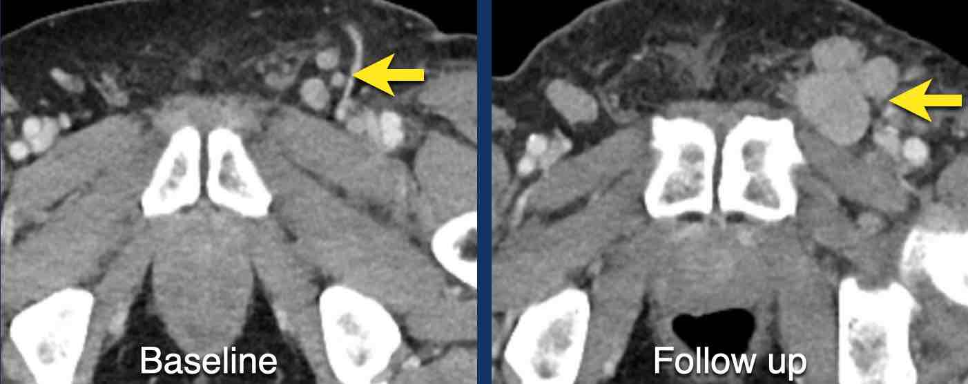 During follow up there is unequivocal progression of lymph node metastases, which were choosen as non-target lesions