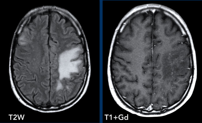 PML-IRIS in a patient with HIV