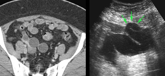 Torsion of hydrosalpinx.