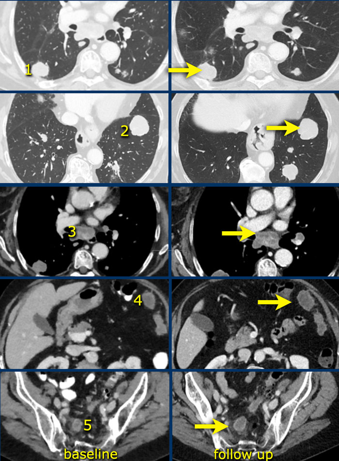 Stable disease. Increase from baseline is 14%.