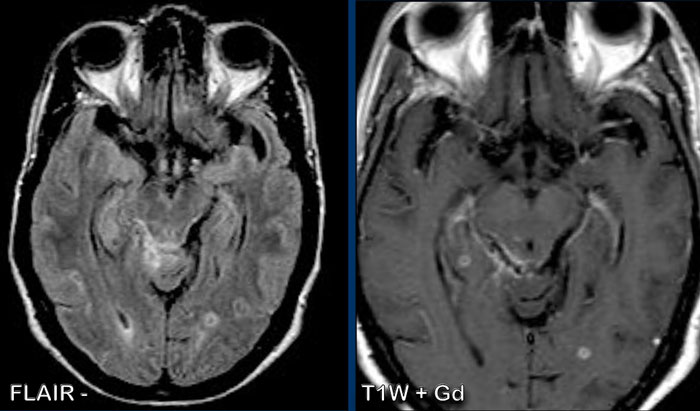 Tuberculous meningitis