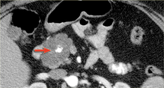 Serous cystic neoplasm with central calcification.