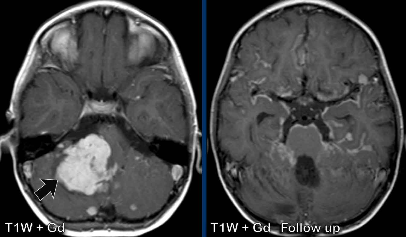 “Sugarcoating” leptomeningeal enhancement in medulloblastoma.