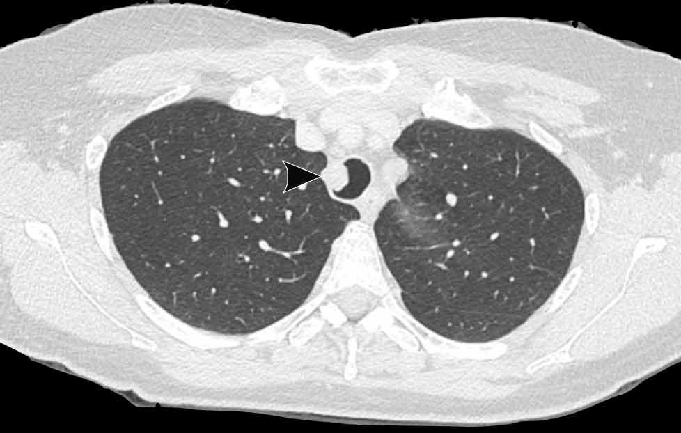 Schwannoma