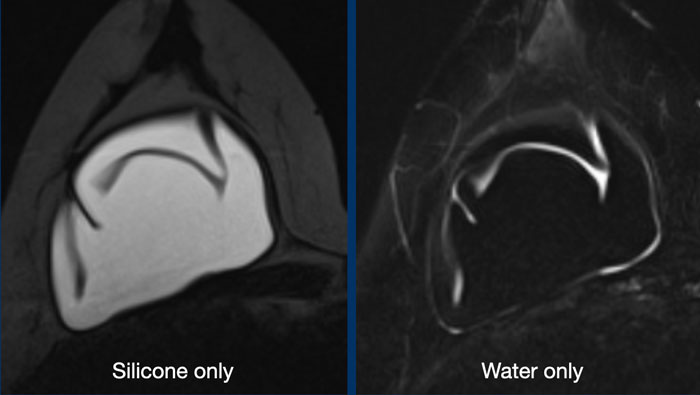 Normal radial folds