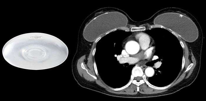 Saline filled prosthesis