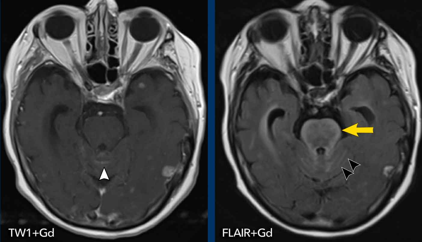 Carcinomatous meningitis in a patient with lungcancer and cerebral metastases.