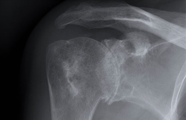 Hemophilic arthropathy of the shoulder