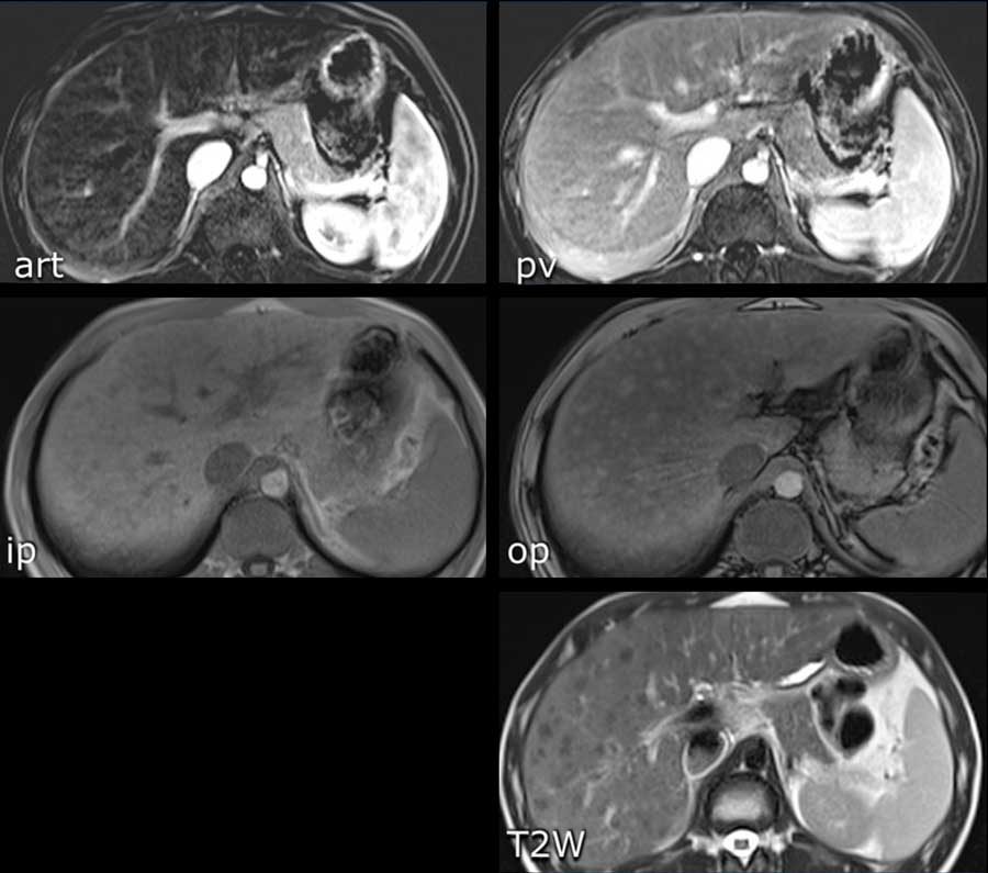 Siderotic nodules