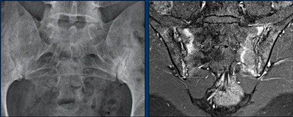 Sacroiliitis in ankylosing spondylitis