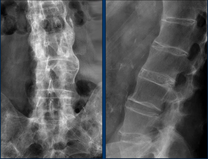 Ankylosing spondylitis