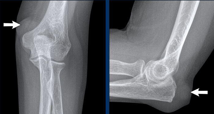 Rheumatic nodule at the elbow