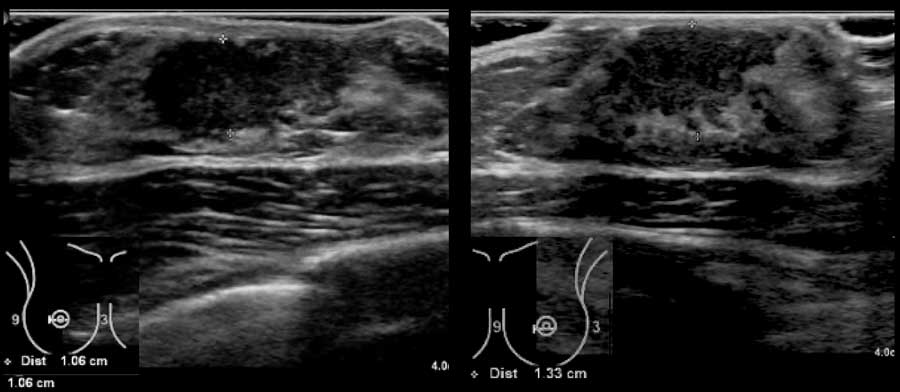 Bilateral gynecomastia in an athlete taking steroids