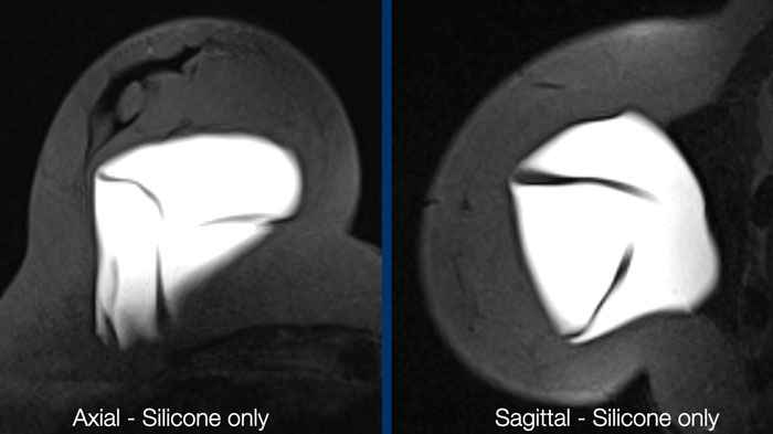 Normal radial folds