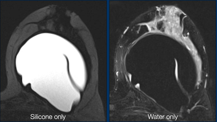 Normal radial folds