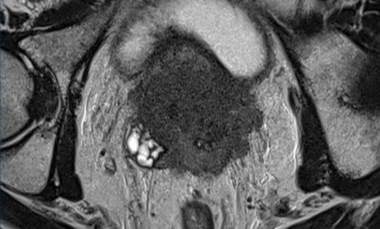 Poorly differentiated adenocarcinoma of the prostate