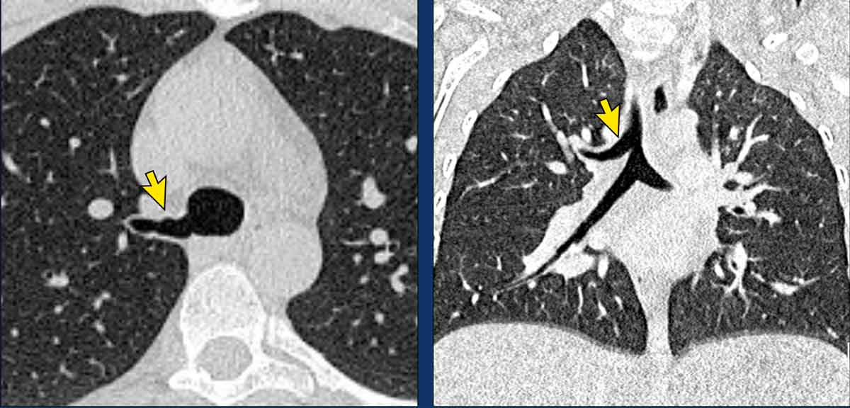 Tracheal bronchus