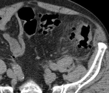 Uncomplicated sigmoid diverticulitis. Fat stranding and focal thickening of the colonic wall in an area with diverticula. No abscess formation.