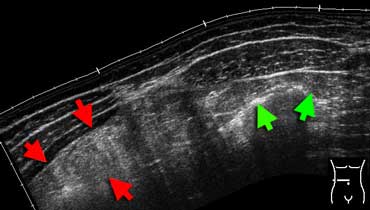 Inflamed fat at sonography. Extended-view of the ventral abdomen  depicting an area of hyperechoic noncompressible inflamed fat in the omentum (red arrows). Compare this to the echogenicity of normal abdominal or subcutaneous fat (green arrows). This patient had an omental infarction.