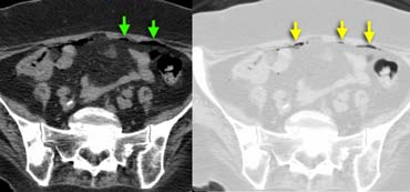 Intraperitoneal air in a patient suspected of having appendicitis. Air better seen on images with lungsetting on the right.