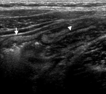 US typically shows submucosal wall thickening (arrowheads) of the terminal ileum and cecum without inflammation of the surrounding fat.