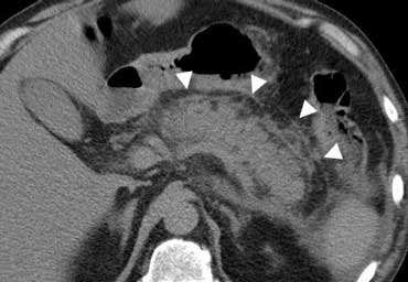 Pancreas surrounded by fat stranding due to exsudative pancreatitis.