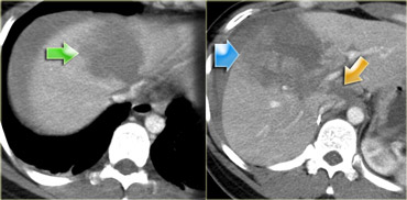 Liver injury. The arrows indicate different types of injury.