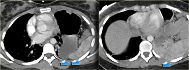 'Dependent viscera' sign in left-sided diafragmatic rupture