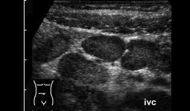 Mesenteric lymphadenitis. Enlarged mesenteric lymph nodes. Appendix was normal.