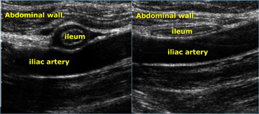 Realtime US allows to observe the effect of compression. Compare the contracted normal  ileum (left) with the relaxed, flattened  ileum in the same patient a few seconds later (right)