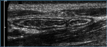 Normal ileum and appendix during compression. Thin habitus of the patient and the application of compression allow the use of a 13.5 MHz transducer with a high image quality.