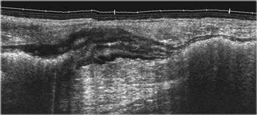 Segmental colitis in Crohn's disease