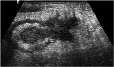 Crohn's ileitis with transmural inflammation and abscess formation.