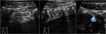 Infectious ileocecitis. US reveals mucosal and submucosal wall thickening. The ascending colon is contracted with prominent haustration. The appendix is normal (arrow).