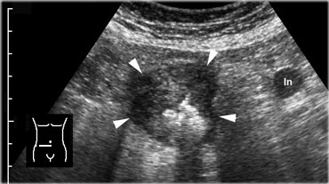 Cecal carcinoma. US reveals asymmetric, hypoechoic, circumferential wall thickening of the cecum (arrowheads) with narrowing of the lumen. There is one pathologically enlarged lymph node.