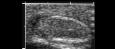 Small testis in a very young child, difficult to differentiate from the surrounding fat