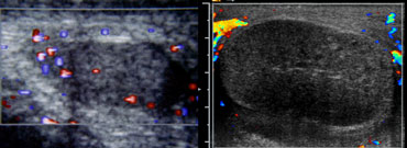 Two cases of torsio testis. 