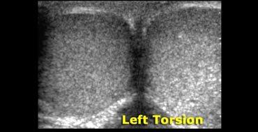 A difference in echogenicity means poor outcome.