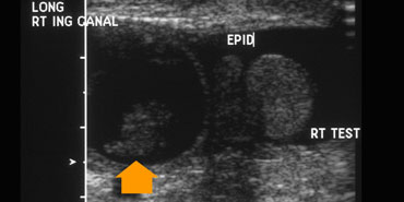 Longitudinal view of inguinal canal. The herniated bowel is seen next to the testis (arrow).